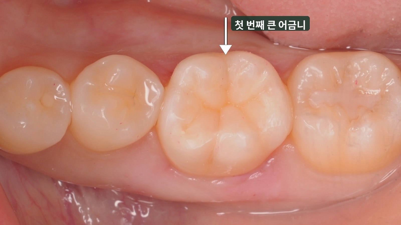 치료 후: 같은 첫 번째 큰 어금니의 씹는 면이 레진으로 교두와 홈까지 원래 치아 모양대로 회복됨