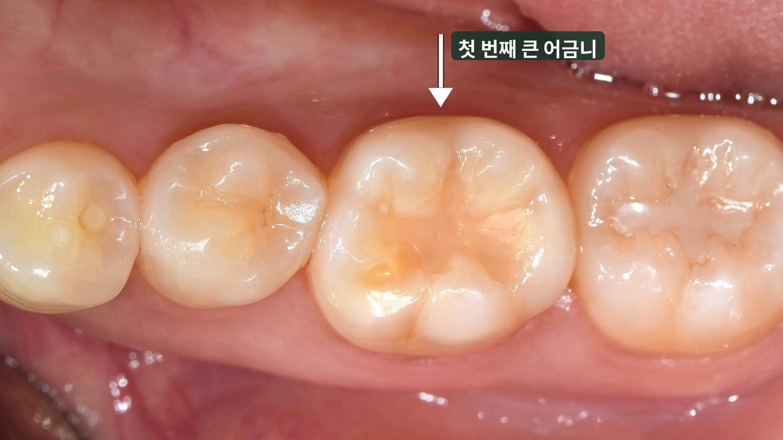 치료 전: 화살표로 표시한 첫 번째 큰 어금니의 씹는 면 가운데가 닳아 패이고 누렇게 드러나 있음