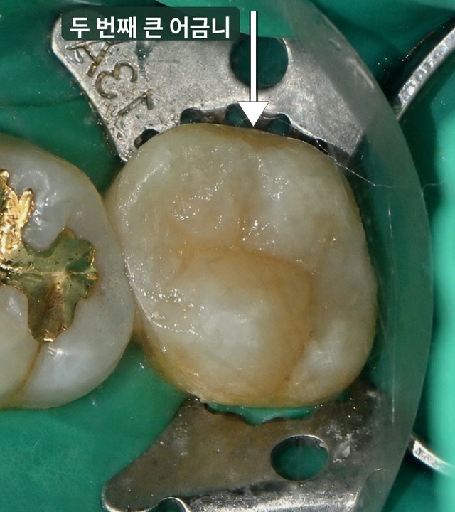 치료 후 두 번째 큰 어금니