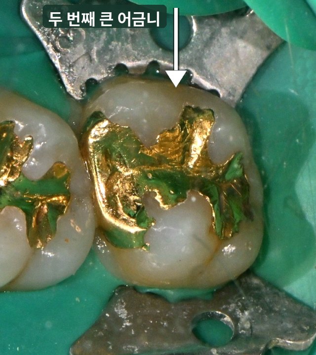 치료 전 두 번째 큰 어금니